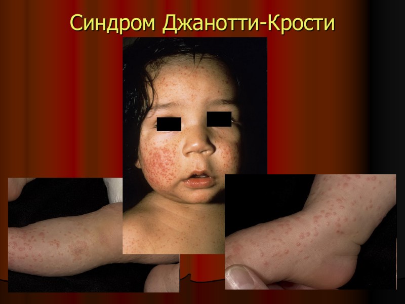 Синдром Джанотти-Крости Синдром Джанотти-Крости